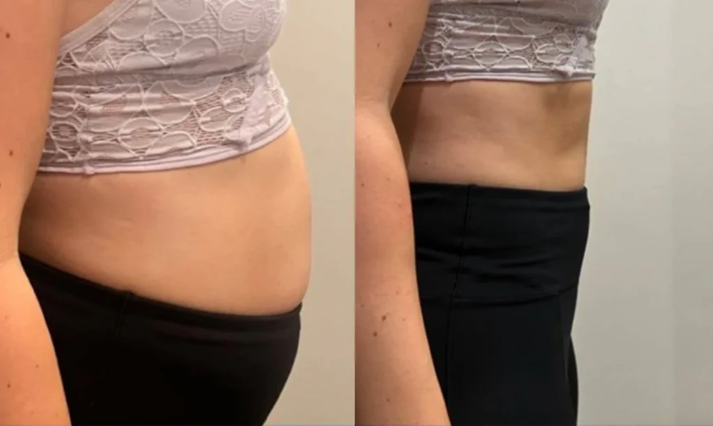 Antes e depois de Renata M.